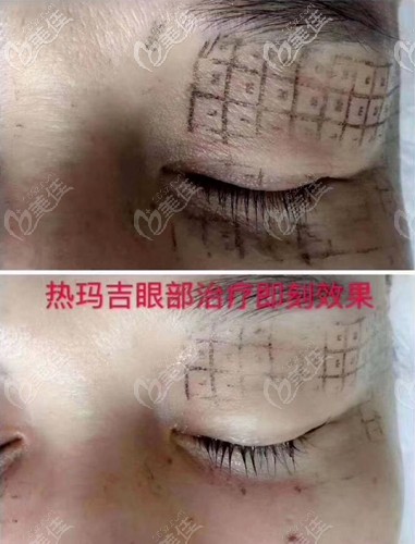 眼部熱瑪吉即刻效果 眼部熱瑪吉即刻效果