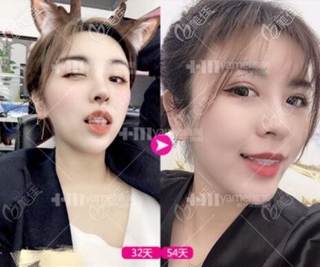 做完第四代熱瑪吉一個月后的效果