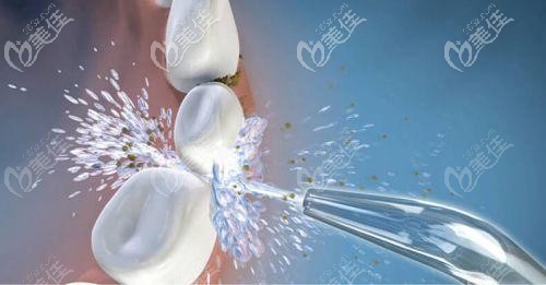 洗牙的外觀示意圖 洗牙的外觀示意圖