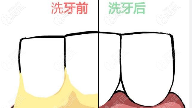 洗牙前后對(duì)比 洗牙前后對(duì)比