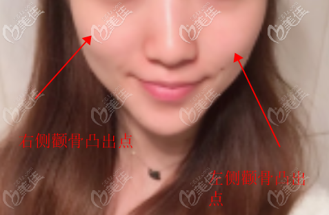 右側(cè)顴骨比左側(cè)顴骨凸出0.5公分 右側(cè)顴骨比左側(cè)顴骨凸出0.5公分