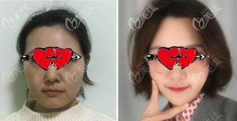 成都銅雀臺(tái)熱瑪吉全臉20天效果對(duì)比