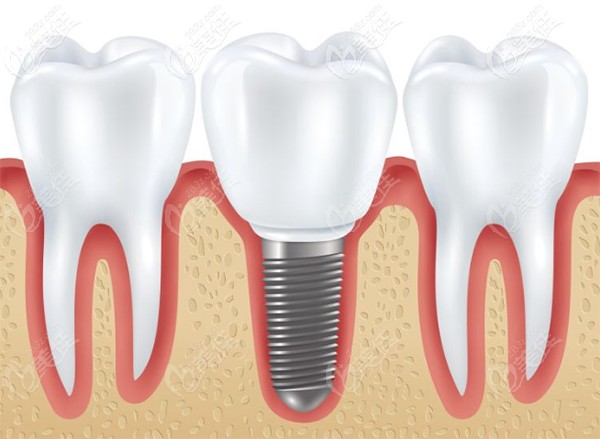 廣州圣貝做進口種植牙的補貼福利