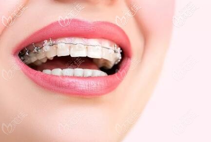 陶瓷半隱形矯正