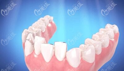 無托槽隱形矯治