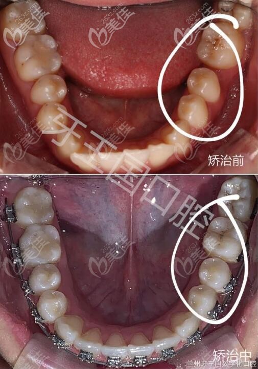 缺牙智齒牽引成功啦,金屬自鎖托槽矯正歷時1年半關閉間隙