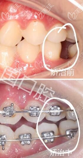 蘭州牙王國(guó)數(shù)字化口腔 正畸關(guān)閉間隙