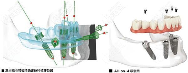3D導(dǎo)板數(shù)字種植牙的優(yōu)勢