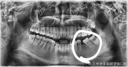 智齒拉過(guò)來(lái)當(dāng)磨牙 蘭州牙王國(guó)口腔