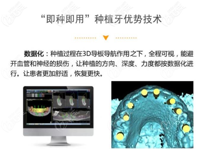 南京卡瓦口腔即刻種植牙怎么樣