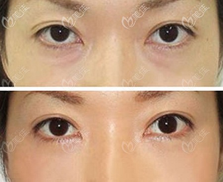 滄州靜港內(nèi)切去眼袋案例