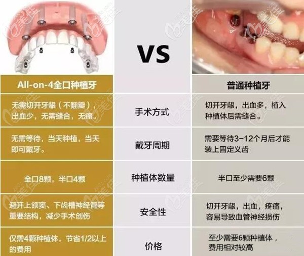南寧牙百年口腔allon4種植牙優(yōu)勢 南寧牙百年口腔allon4種植牙優(yōu)勢