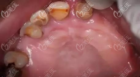 南寧牙百年口腔上頜種植牙前的照片 南寧牙百年口腔上頜種植牙前的照片