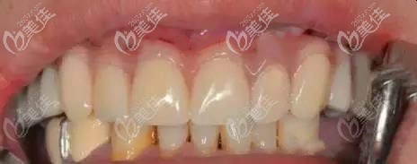 南寧牙百年口腔星湖店的上頜即拔即種3D導(dǎo)板種植牙案例已公開