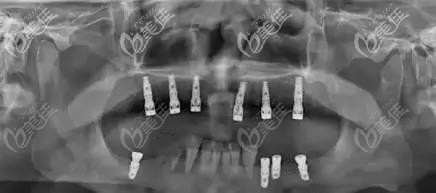 南寧牙百年口腔上頜種植牙術(shù)后CT 南寧牙百年口腔上頜種植牙術(shù)后CT