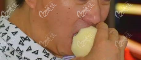 南寧牙百年口腔上半口種植牙案例 南寧牙百年口腔上半口種植牙案例