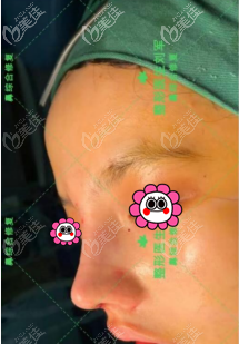 找北京做鼻綜合好的<!--<i data=20240703-sp></i>-->做鼻修復(fù)術(shù)后即刻照