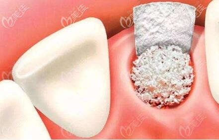 種植牙植骨 種植牙植骨