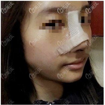 鼻綜合術(shù)后三天效果