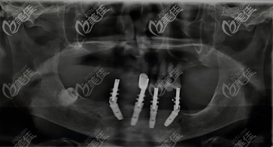 用登騰做全口allon4即刻負(fù)重種植牙讓林大伯當(dāng)場就能啃蘋果