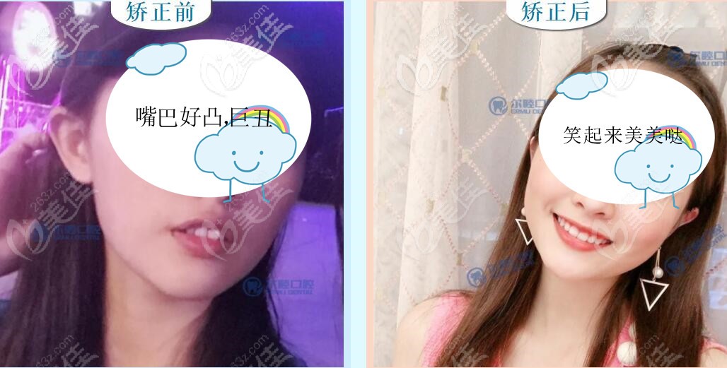 凸面型+前牙深覆合戴時代天使全透明牙套照樣可以矯正，效果我挺滿意的