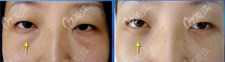 內(nèi)切去眼袋前后效果對(duì)比