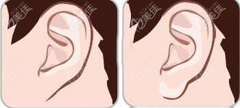 玻尿酸豐耳唇對比效果圖 玻尿酸豐耳唇對比效果圖