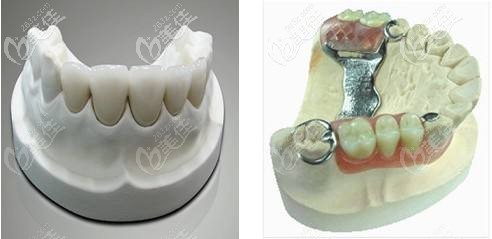 哪些情況適合做活動(dòng)義齒 哪些情況適合做活動(dòng)義齒