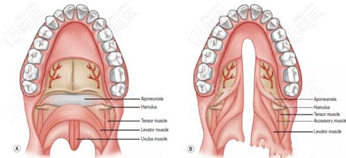 腭裂的情況 腭裂的情況