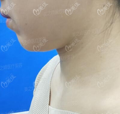 注射嗨體去頸紋術前照 注射嗨體去頸紋術前照