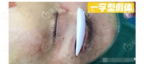 一字型假體豐眉弓