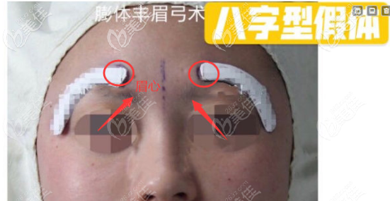 八字型豐眉弓假體