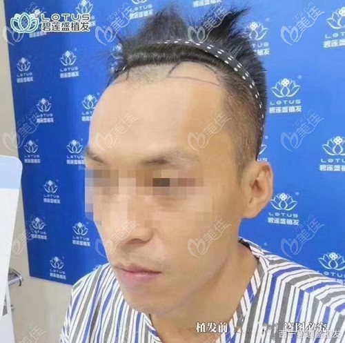 發(fā)際線植發(fā)術前照片 發(fā)際線植發(fā)術前照片