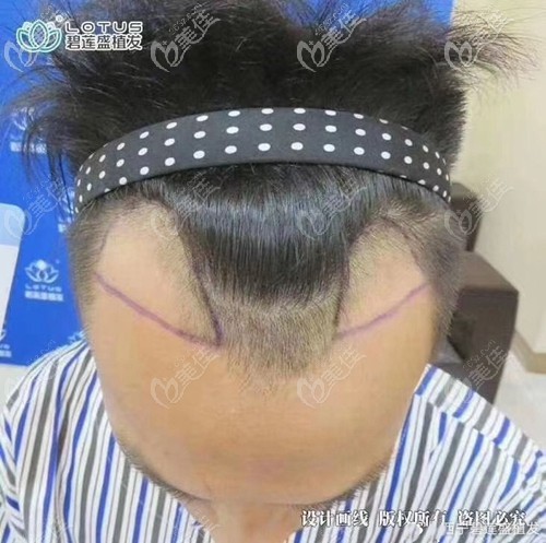 術前設計發(fā)際線種植方案 術前設計發(fā)際線種植方案