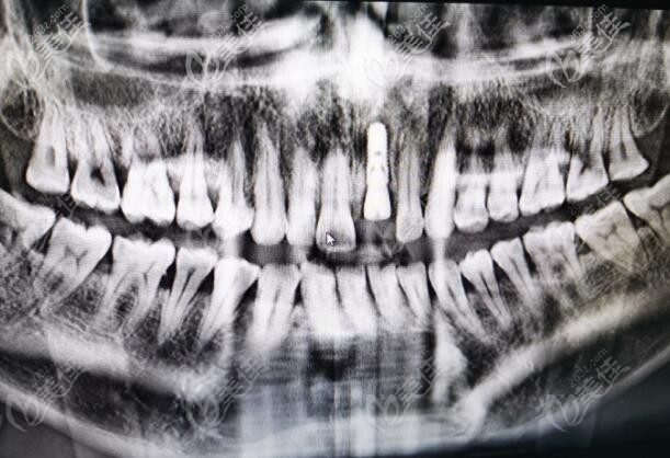  誰(shuí)說(shuō)前門牙種植成功率不高,我在肇慶做的瑞典諾貝爾pcc即刻種植牙效果就挺好的