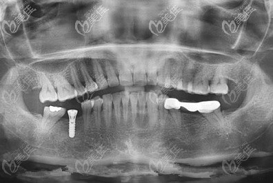 年輕人單顆牙缺失就去做顆瑞士士卓曼ITI種植牙吧