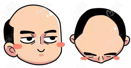 這位發(fā)友目前的脫發(fā)狀況