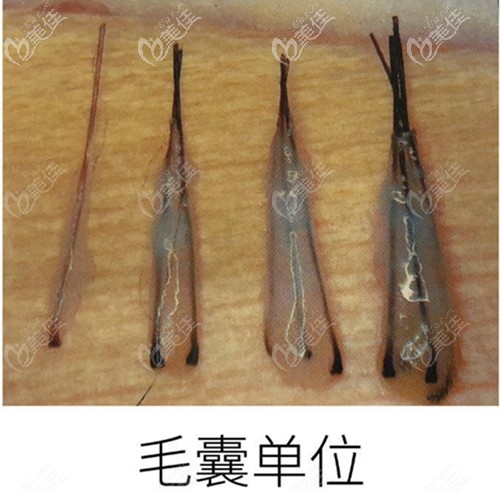 一個毛囊單位里有1-4根頭發(fā)不等