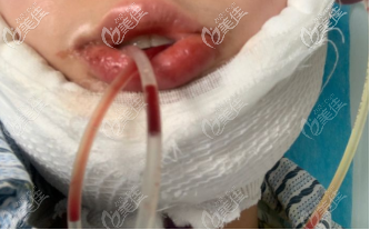 下頜角手術(shù)后插著導(dǎo)流管的樣子 下頜角手術(shù)后插著導(dǎo)流管的樣子