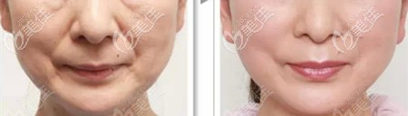 做熱瑪吉前后效果對比 做熱瑪吉前后效果對比