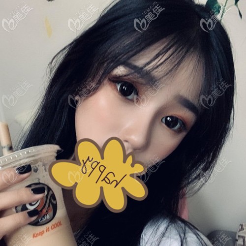 成都盧元剛做的這個土耳其軟糖鼻綜合能拯救多種不美鼻型哦