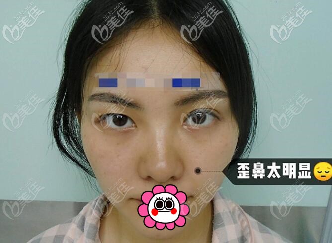 到成都素美做隆鼻前