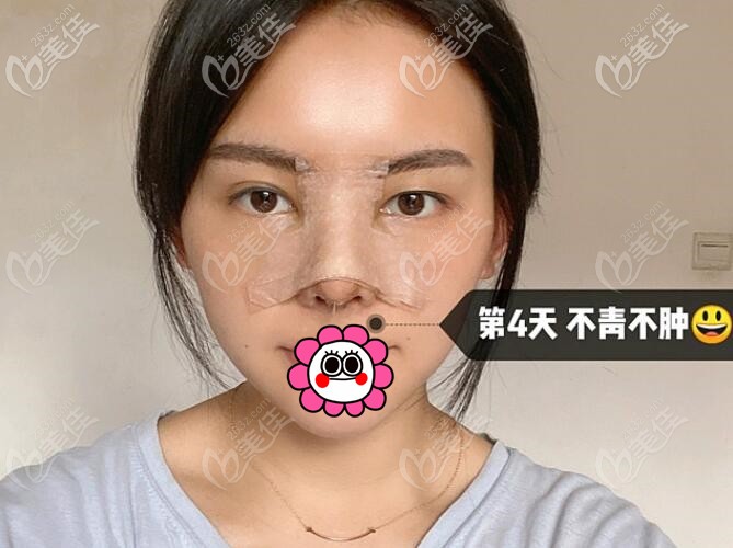 盧元?jiǎng)偮”腔謴?fù)4天已經(jīng)不青不腫