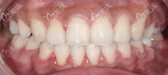 在佛山拜爾牙科矯正牙齒后的效果圖