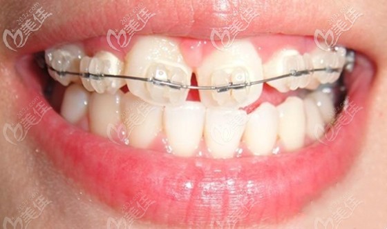 在佛山做牙齒矯正的參考價(jià)格介紹