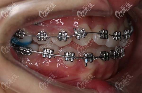 唇側(cè)金屬固定矯正和美國MBT直絲弓矯治 唇側(cè)金屬固定矯正和美國MBT直絲弓矯治