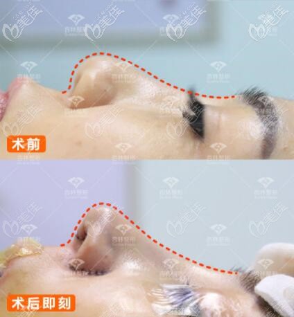 沈陽杏林朱石江肋軟骨隆鼻真人案例對比圖 沈陽杏林朱石江肋軟骨隆鼻真人案例對比圖