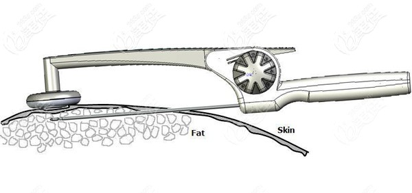 黃金微雕溶脂的原理 黃金微雕溶脂的原理