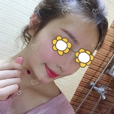 熱瑪吉提拉術(shù)后20天還有點(diǎn)輕微腫脹但提拉明顯 熱瑪吉提拉術(shù)后20天還有點(diǎn)輕微腫脹但提拉明顯