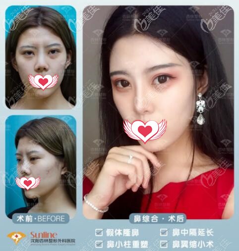 沈陽杏林鼻綜合真人案例前后對比照 沈陽杏林鼻綜合真人案例前后對比照